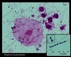 streptococcus pneumoniae in sputum(microscopy)
